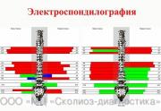 Электроспондилография - Диагностический комплекс «Медискрин-Вертебро» предназначен для измерения электрохимической проводимости в двадцати четырех зонах на коже человека, соответствующих местам выхода спинномозговых нервов.
Метод обладает большими потенциальными возможностями по выявлению патологии позвоночного столба, как протекающей латентно, т.е. без клинических проявлений, так и в острый период течения (прежде всего – межпозвоночных грыж, протрузий межпозвоночных дисков на ранних стадиях). Кроме того, метод обладает достаточно высокой чувствительностью к различным видам патологии позвоночного столба и заболеваний внутренних органов, развившихся вследствие болезни позвоночника.
Электроспондилография предназначена для:
оценки функционального состояния позвоночного столба и позвоночной системы (выявления причин болей);
динамического наблюдения за состоянием здоровья;
составления индивидуальной схемы лечения, в том числе, методом мануальной терапии, рефлексотерапии;
оценки эффективности лечения;
массового диспансерного обследования населения;
повторных периодических (1 раз в 3 месяца) обследований пациентов «группы риска» с целью контроля динамики развития функциональных нарушений при заболеваниях позвоночника.